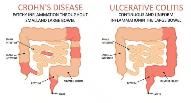 L-Glutamine and Inflammatory Bowel Disease: Exploring the Potential Benefits