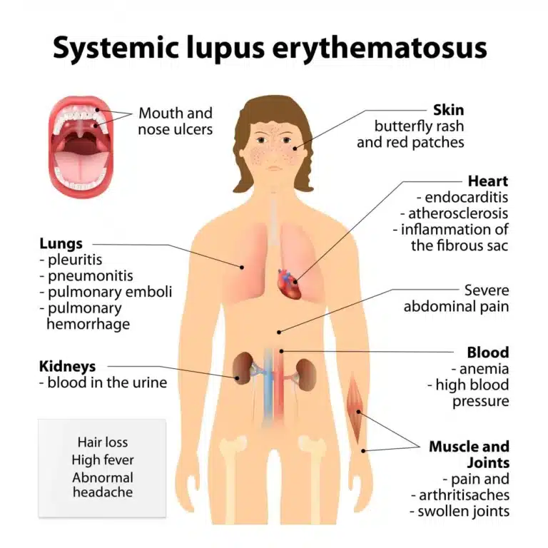 Understanding How Glutathione Can Benefit Those with Lupus