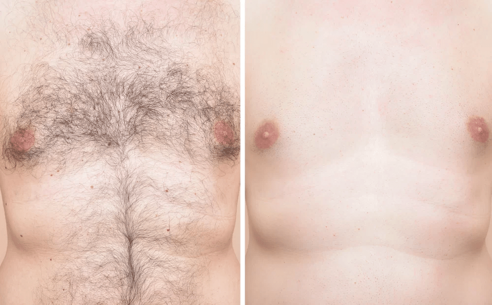 what to do before and after laser hair removal